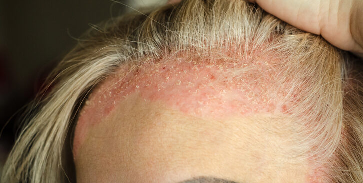 psoriasi,-dermatologi-e-medici-di-famiglia-alleati-per-diagnosi-precoce-e-aderenza-terapeutica