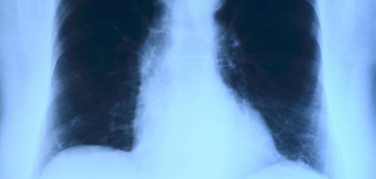 colpa-grave-la-lettura-sbagliata-di-una-radiografia