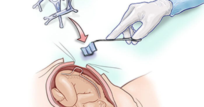spina-bifida,-un-cerotto-di-staminali-cura-tre-bebe-in-utero