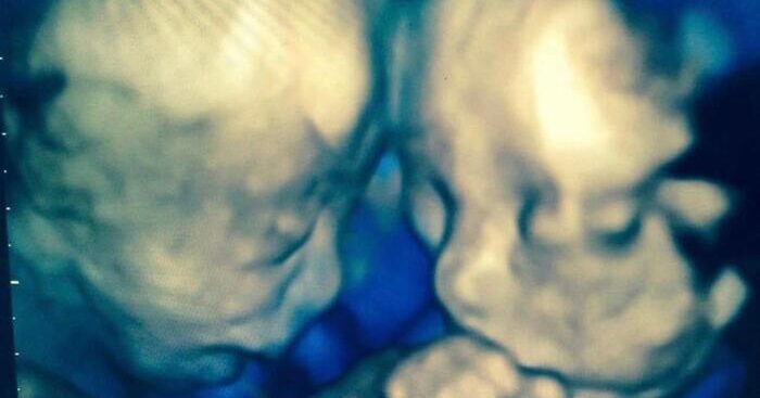 sindrome-trasfusione-fetale,al-bambino-gesu-25/mo-intervento