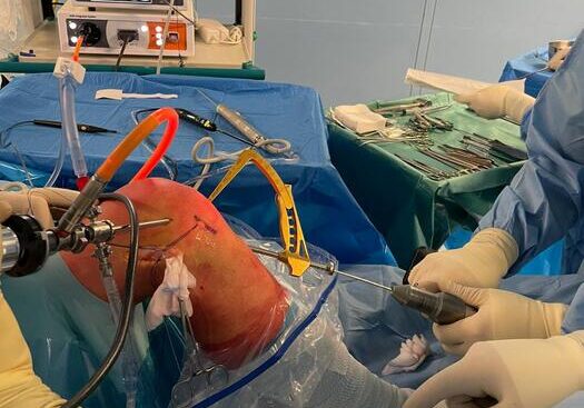 trapianto-da-vivo-per-ricostruire-legamento,-primo-in-italia