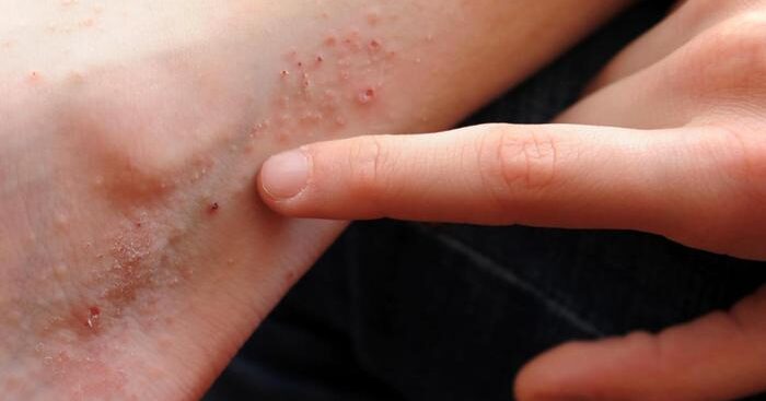 eczema,-colpisce-il-6%-di-bambini-e-adolescenti-nel-mondo