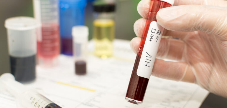 hiv:-un-“modello”-sicilia-che-va-incontro-ai-pazienti