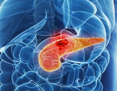 tumore-al-pancreas-possibile-identificarlo-con-tre-anni-di-anticipo-grazie-all’intelligenza-artificiale.
