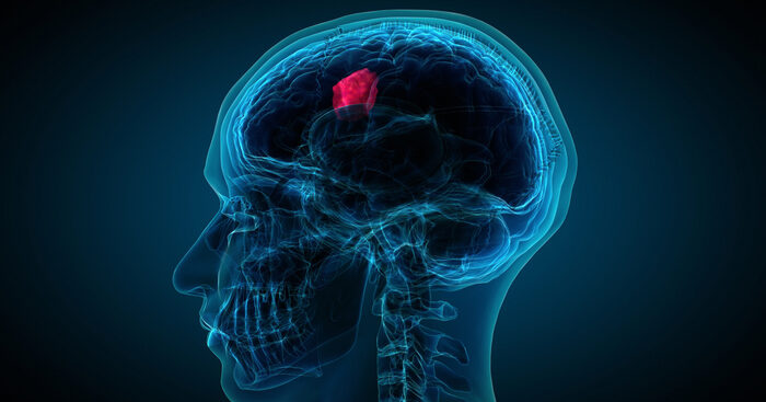 contro-il-glioblastoma-funziona-la-terapia-con-i-campi-elettrici