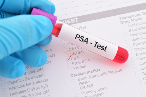 tumore-alla-prostata:-50-anni-fa-la-prima-protesi,-nel-futuro-sara-comandata-dal-cervello.-ma-solo-un-uomo-su-10-la-ottiene