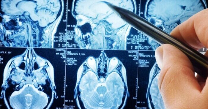 adhd,-test-progettati-per-fornire-diagnosi-piu-scientifiche