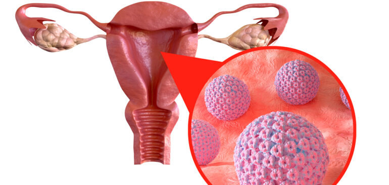 papilloma-virus-(hpv),-la-ricerca-affila-le-armi-per-battere-la-persistenza