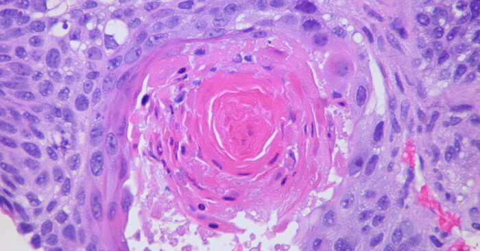 tumore-polmone,-28%-rischio-morte-con-immunoterapia-pre-e-post 