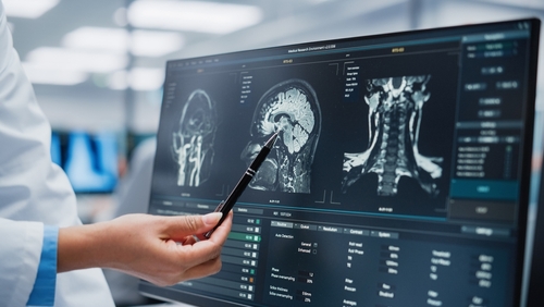 neurologia:-diagnosi-precoci-e-accurate-grazie-alla-medicina-di-precisione
