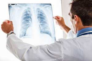 carcinoma-polmonare-non-a-piccole-cellule-alk-positivo-in-stadio-iniziale:-alectinib-riduce-il-rischio-di-recidiva-o-decesso-del-76%-dopo-resezione-chirurgica