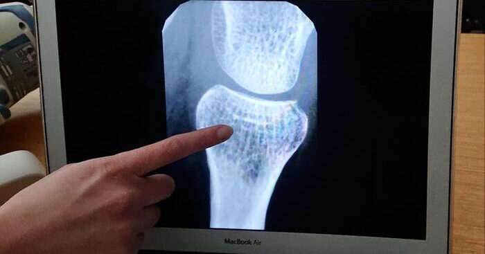 oggi-si-celebra-la-giornata-mondiale-dell’ipofosfatasia