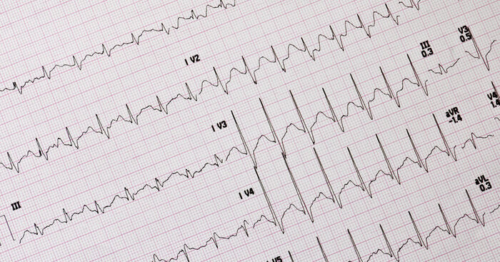 l’ia-potra-battere-il-cardiologo-nella-diagnosi-di-infarto