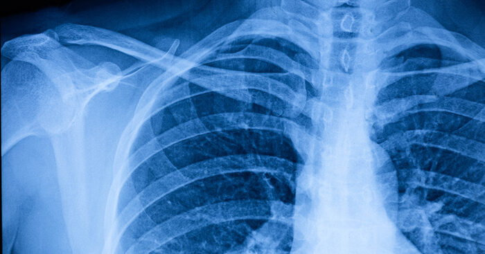 stress-negli-ospedali,-polmoniti-da-influenza-fra-giovani