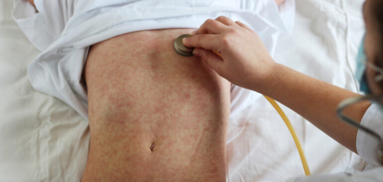 morbillo,-iss:-“nel-2023-casi-in-netta-risalita:-almeno-una-complicanza-nel-26%-dei-contagiati”
