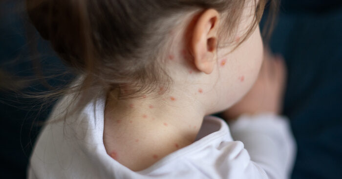morbillo,-a-giugno-1.891-casi-in-europa-e-150-in-italia