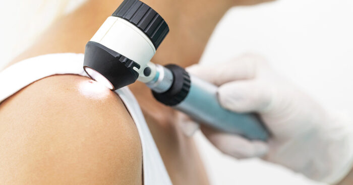 melanoma,-+30%-di-diagnosi-nel-2024-ma-cresce-l’immunoterapia