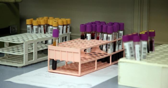 anemia-mediterranea-legata-a-invecchiamento-precoce-cervello