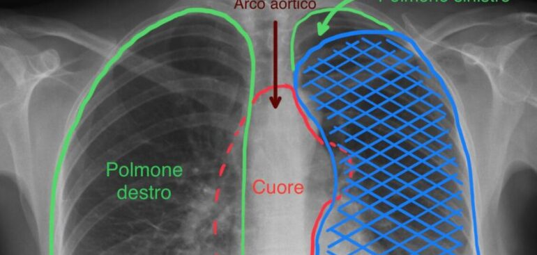 grande-tumore-asportato-alle-molinette-sollevando-il-cuore