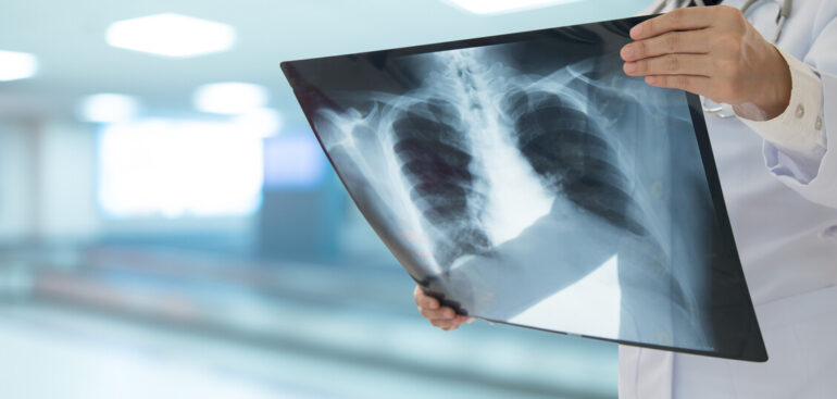 piu-casi-di-tubercolosi-in-europa,-1-su-20-ha-meno-di-15-anni