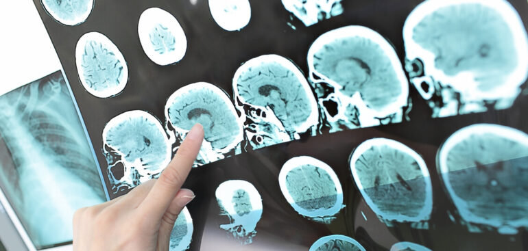 dall’iss-linee-guida-per-diagnosi-e-cura-di-2-effetti-dell’ictus