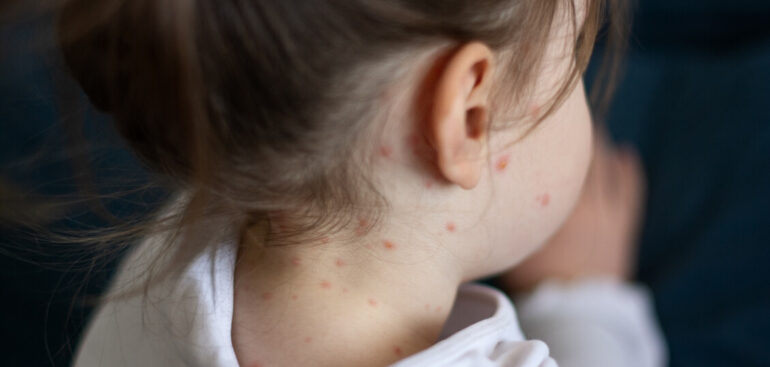 negli-usa-allerta-morbillo,-i-casi-ai-massimi-dal-1992