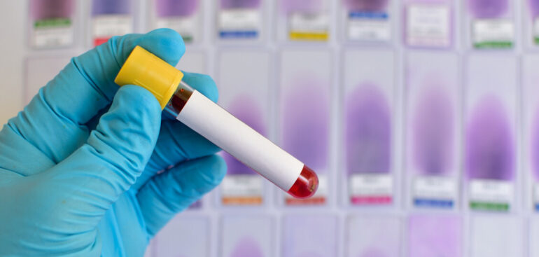 iss,-in-arrivo-un-piano-nazionale-contro-epatiti-e-hiv