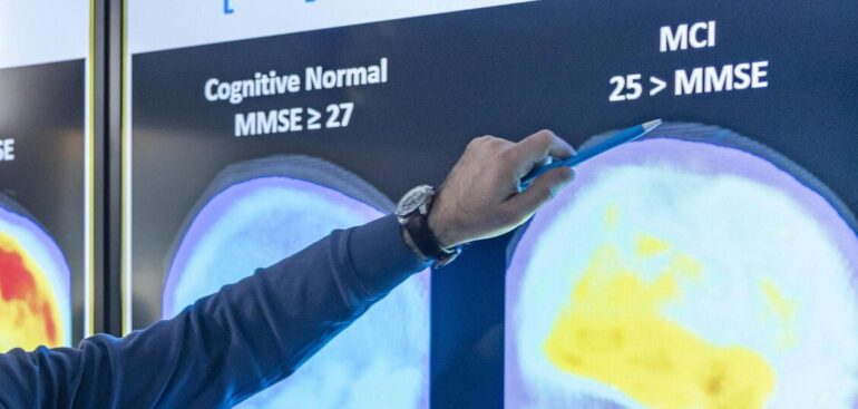 servono-3,5-4,1-anni-per-diagnosi-alzheimer-da-comparsa-sintomi
