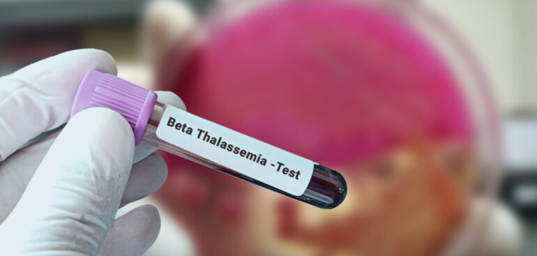 rimborso-a-terapia-genetica-per-β-talassemia-e-anemia-falci