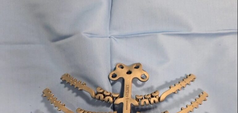 a-modena-sterno-in-titanio-su-paziente-affetta-da-carcinoma