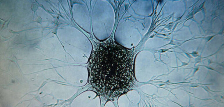 speciale-congresso-esmo.-tumori-neuroendocrini,-molecola-riduce-dell’81%-l’aggravamento-della-neoplasia