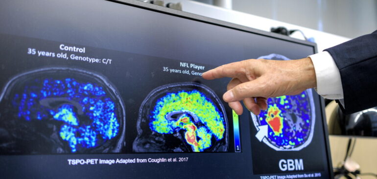 alzheimer,-con-molecole-killer-diagnosi-20-anni-prima-di-sintomi