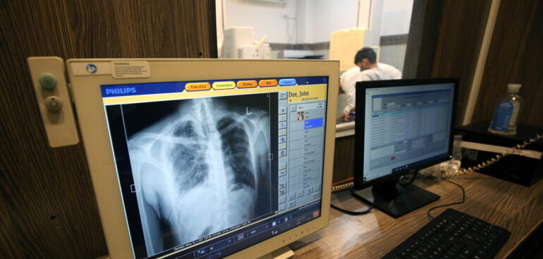 tumore-del-sacro,-pari-efficacia-tra-chirurgia-e-radioterapia