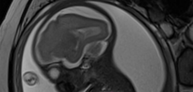 >ansa-la-storia/operato-in-utero-per-una-cisti-grande-come-un’arancia,-sta-bene