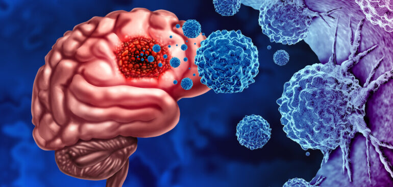 glioblastoma,-si-punta-a-creare-modelli-del-tumore-con-stampa-3d