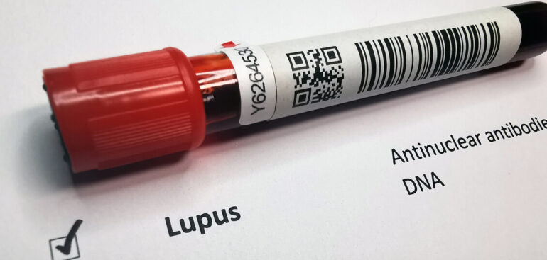 lupus,-23-mila-colpiti-in-italia-e-una-diagnosi-lunga-4-6-anni.-via-a-registro
