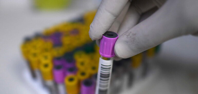 tubercolosi,-verso-test-sangue-ultra-sensibile-per-diagnosi-infezione-latente-o-iniziale