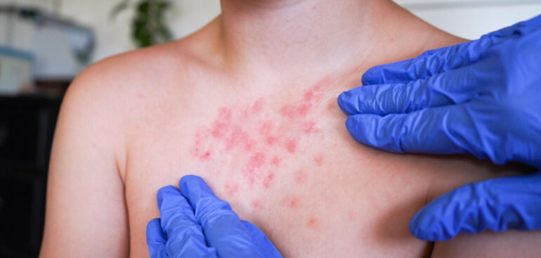 scabbia-piu-resistente-al-trattamento-terapeutico-tradizionale,-la-permetrina