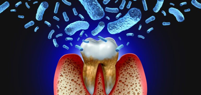 sviluppata-una-terapia-mirata-per-la-parodontite-basata-sulla-luce
