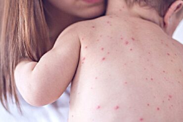 ecdc,-‘2.339-casi-di-morbillo-nell’ue-in-un-anno-e-nessun-decesso’