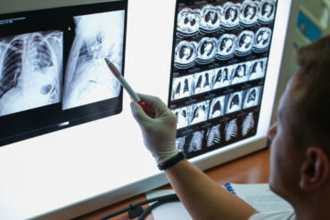 tumore-al-polmone,-l’ia-aiuta-a-predire-la-risposta-all’immunoterapia