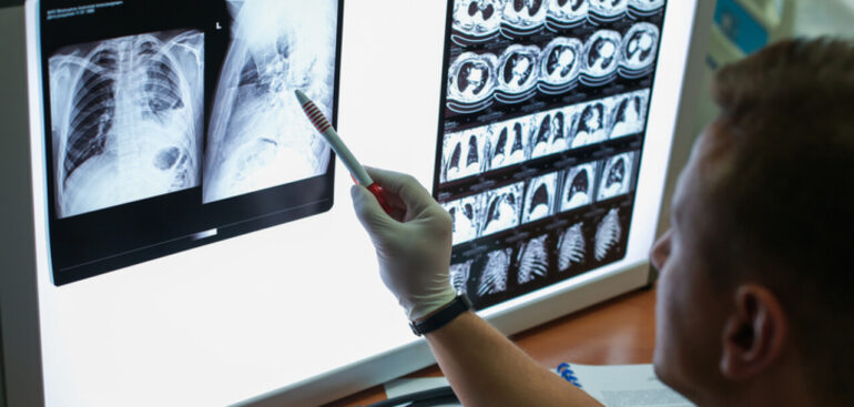 tumore-al-polmone,-l’ia-aiuta-a-predire-la-risposta-all’immunoterapia