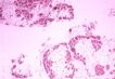 distrofia-muscolare-duchenne,-nuovo-farmaco-migliora-la-qualita-di-vita