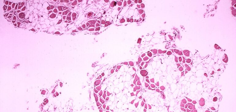 distrofia-muscolare-duchenne,-nuovo-farmaco-migliora-la-qualita-di-vita