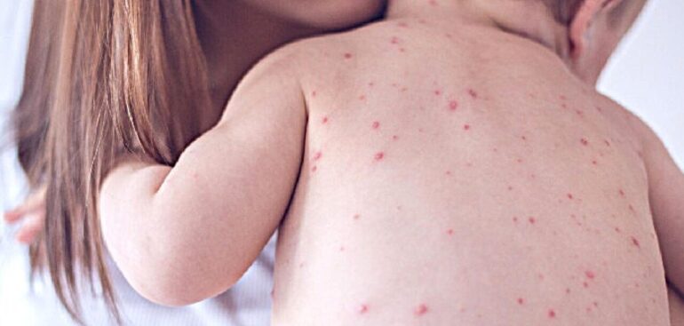 aumentano-i-casi-di-morbillo,-‘piu-vigilanza-e-vaccinazioni’