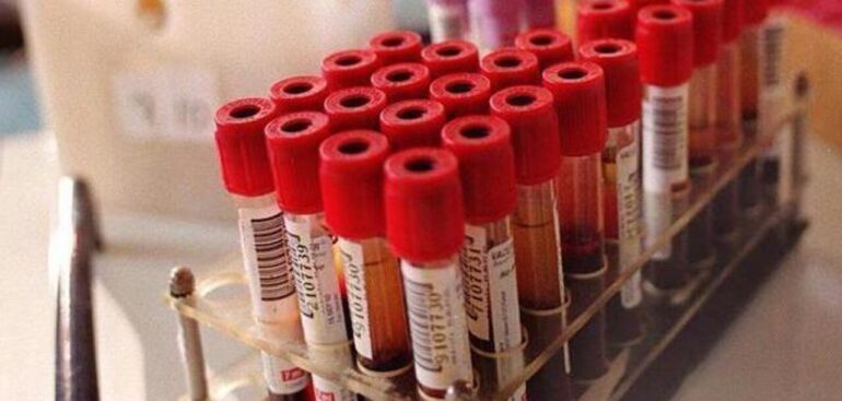 analisi-del-sangue-a-digiuno-o-no?-uno-studio-fa-chiarezza-sugli-esami-per-cui-serve