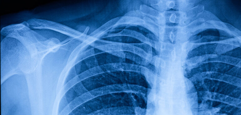 il-papa-e-il-nodulo-polmonare,-ecco-come-si-diagnostica-e-quando-si-interviene