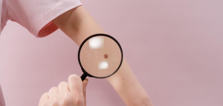 melanoma,-una-pillola-‘mette-a-nudo’-il-tumore-e-ne-rallenta-la-crescita