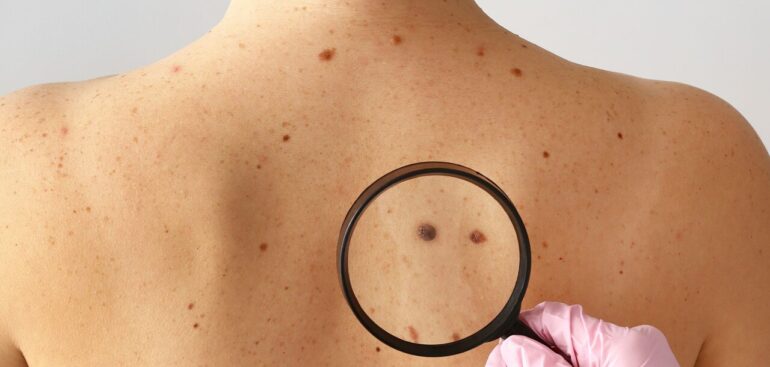 melanoma,-primo-vaccino-‘su-misura’-riduce-il-rischio-di-recidiva-del-42%
