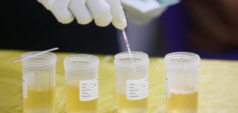 fentanyl,-possibili-falsi-positivi-nei-test-rapidi-in-presenza-di-un-farmaco